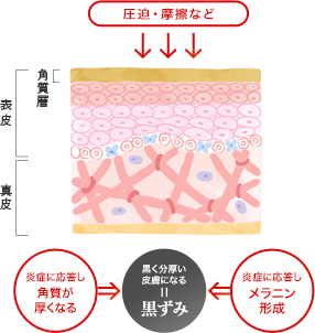 メラニン形成と角化による黒ずみ